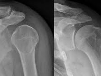 A person met with an accident in which two long bones of hand were dislocated. Why did this happen?
